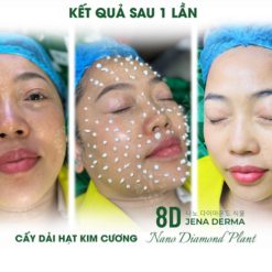 Bộ cấy dải hạt kim cương 8d jena derma